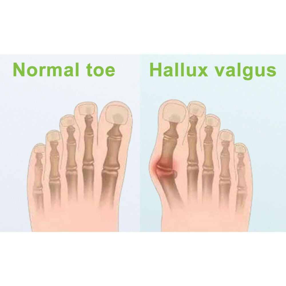 Silicone Gel Toe Separator Orthotics Bunion Toes Spacer Pain Reliever 12Pcs