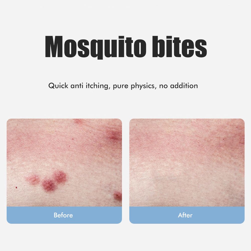 Bug Bite Itch Relief Tool USB Rechargeable Mosquito Bite Sucker Chemical Free for Bug Bites Bee Wasp Stings