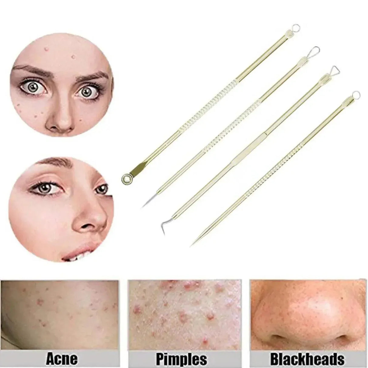 Stainless Steel Blackhead Remover Tools Set with Pimple Extractors 4 Pieces - Black
