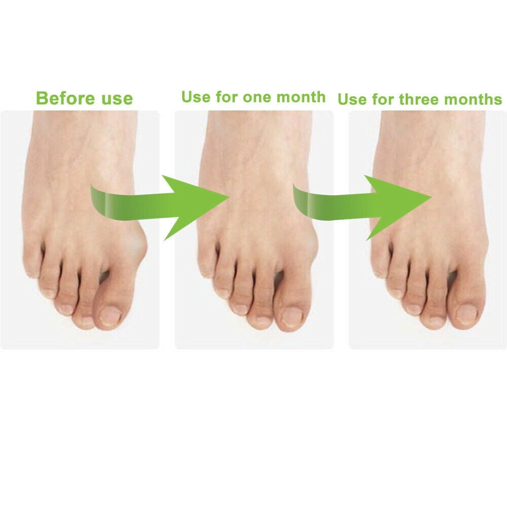 Silicone Gel Toe Separator Orthotics Bunion Toes Spacer Pain Reliever 12Pcs