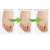 Silicone Gel Toe Separator Orthotics Bunion Toes Spacer Pain Reliever 12Pcs - Front View