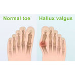 Silicone Gel Toe Separator Orthotics Bunion Toes Spacer Pain Reliever 12Pcs