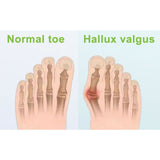 Silicone Gel Toe Separator Orthotics Bunion Toes Spacer Pain Reliever 12Pcs - Side View
