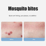 Bug Bite Itch Relief Tool USB Rechargeable Mosquito Bite Sucker Chemical Free for Bug Bites Bee Wasp Stings - Top-Down View