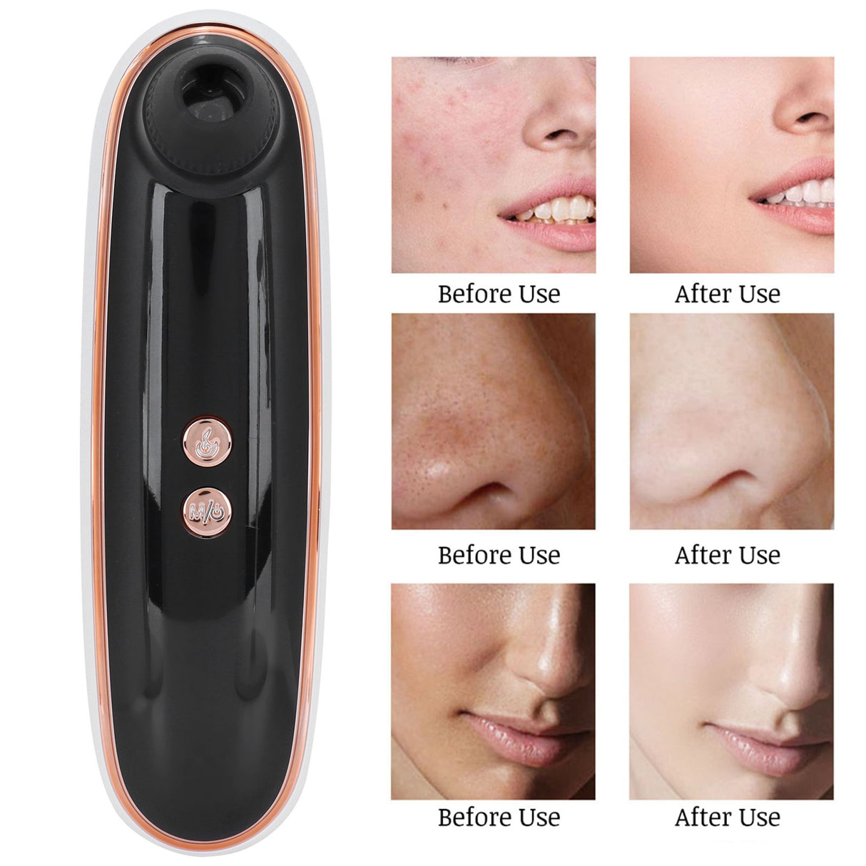 Blackhead Acnes Removal Machine Multifunction Visual Face Cleaner Device USB Charging