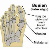 Bunion Corrector Hammer Toe Splint Straightener Orthopedic Brace Hallux Valgus - Extra Image